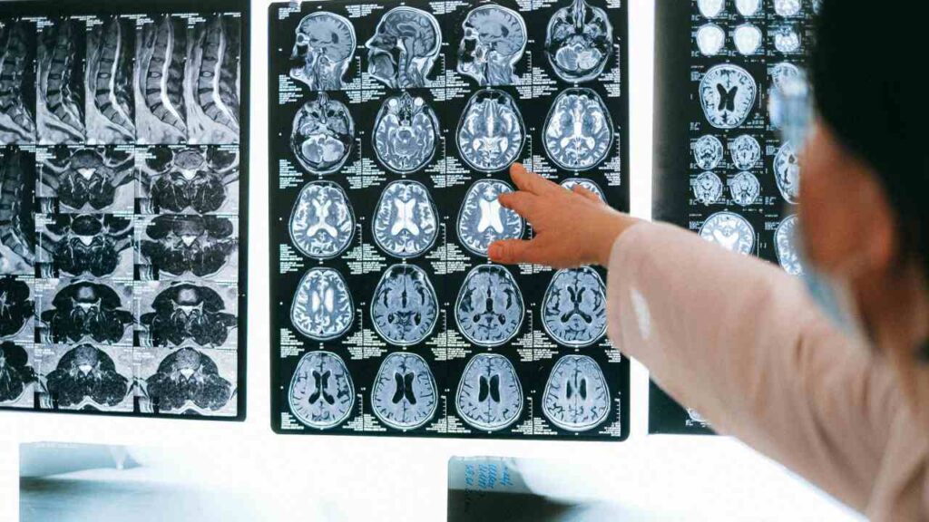 Radiografie, Meningite pexels shvetsa